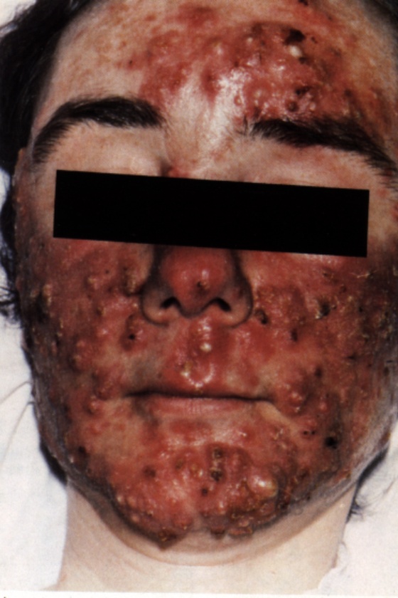 [Image: acne-6.jpg]